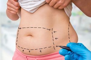 liposuction surgery in female body