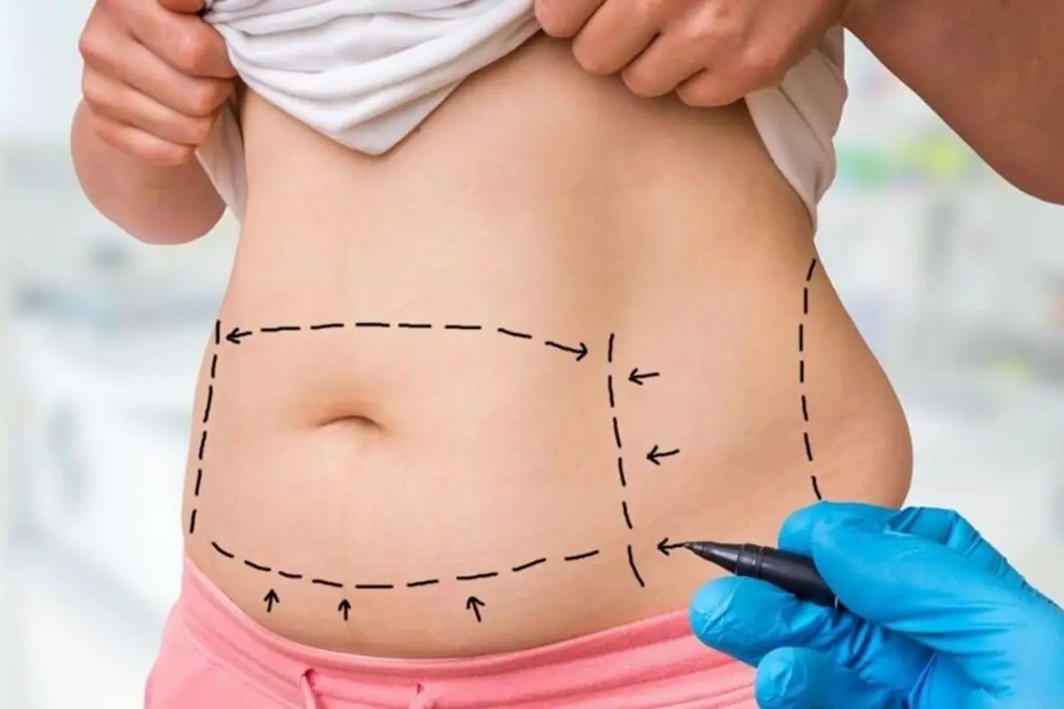 liposuction surgery in female body