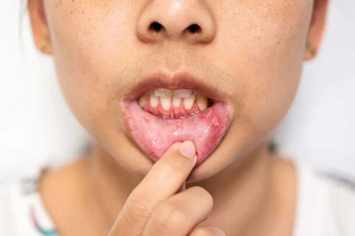 Asian woman with canker sore on her lip