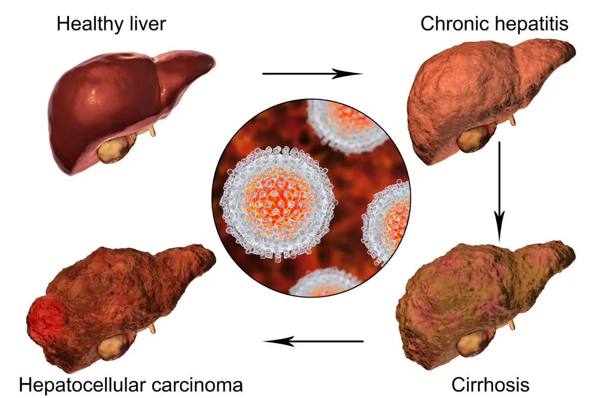 liver disease caffeine sensitivity