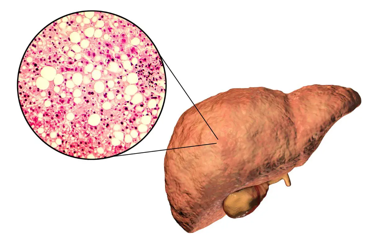 liver disease caffeine 